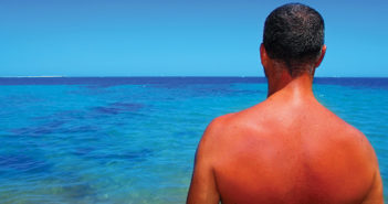 man with sunburn staring at the ocean